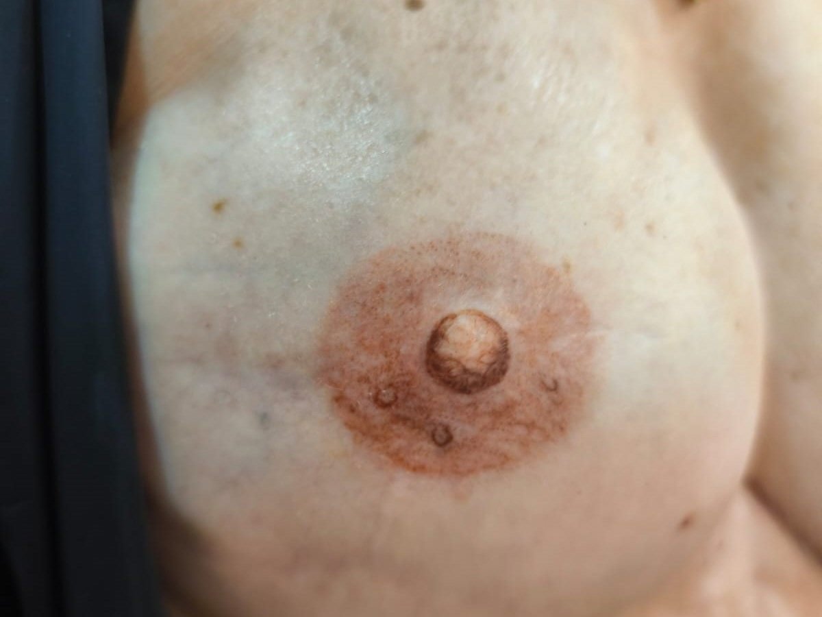 30 dias — Evolução em 30 dias, reconstrução estética de aréola